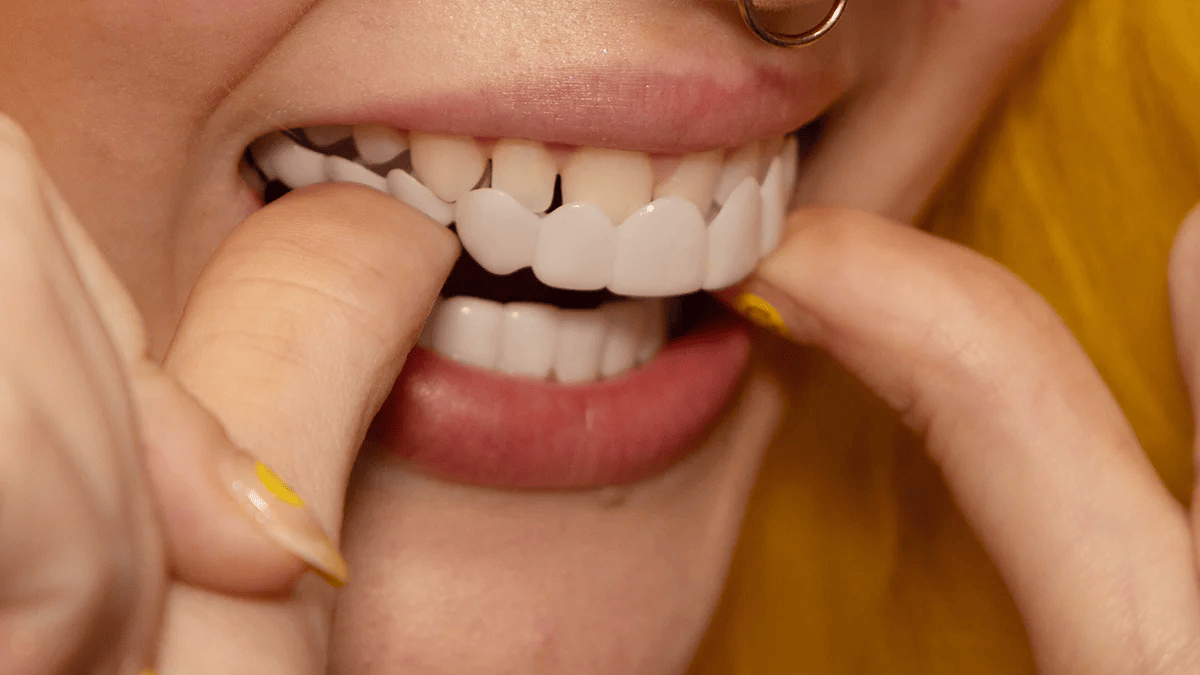 Dentalis | Sofortige Lächelverwandlung mit Snap on Smile Veneers