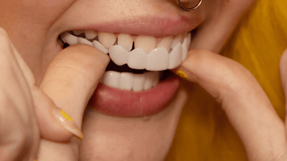 Dentalis | Sofortige Lächelverwandlung mit Snap on Smile Veneers